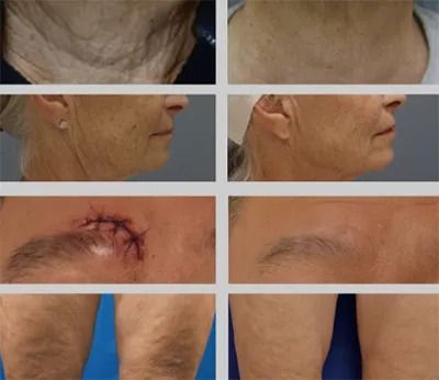 Comparison of aging skin and healing wounds.