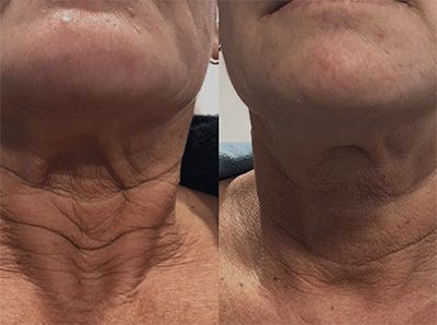 Before and after of neck skin treatment.