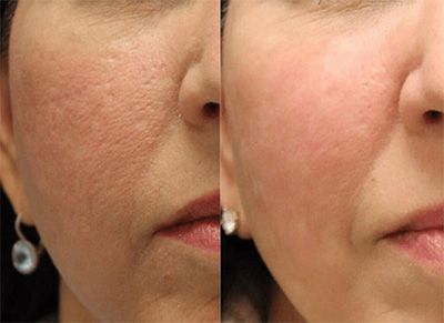 Before and after skin treatment comparison.