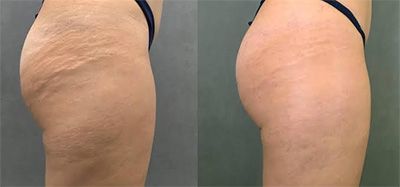 Before and after skin texture comparison.