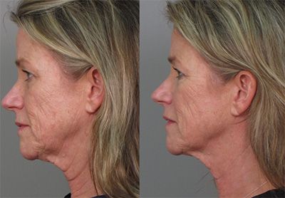 Before and after Santa Fe Ultherapy.