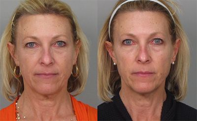 Before and after Santa Fe Ultherapy.