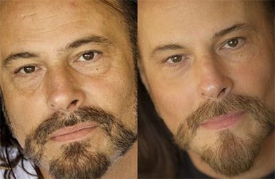 Santa Fe Ultherapy before and after.