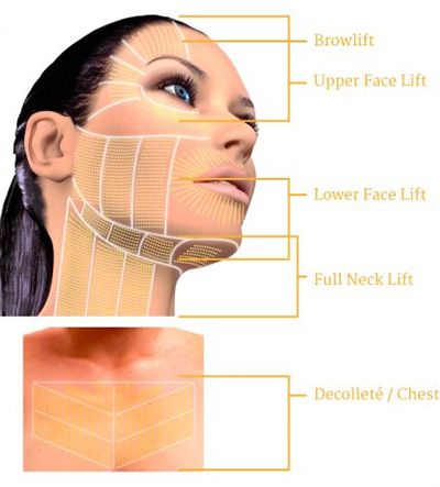 Facial lifting techniques and areas illustrated diagrammatically, for Santa Fe Ultherapy.